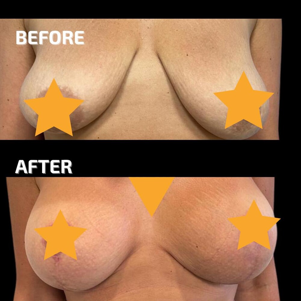 Before and After Result